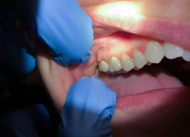 Best Emergency Treatment for Oral Infections in Columbia, MS